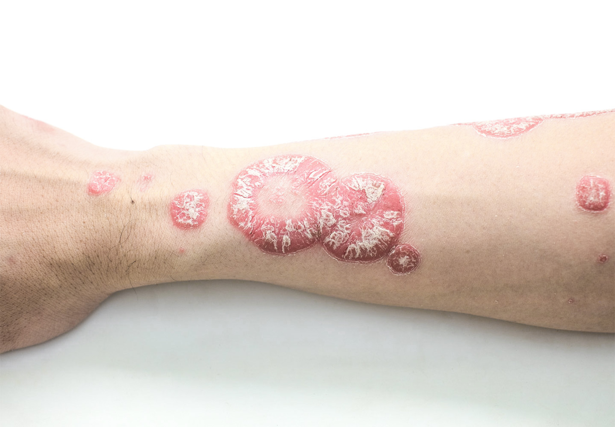 Vitiligo - Egy titokzatos bőrbetegség